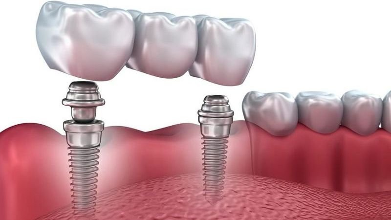 bone grafting